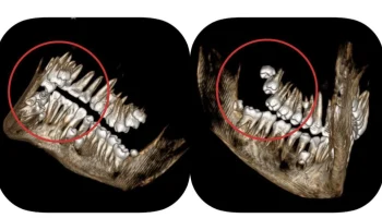 У подростка нашли 14 лишних зубов: почему так происходит и насколько это опасно