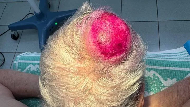 Подмосковные врачи успешно удалили кисту, с которой женщина ходила 30 лет