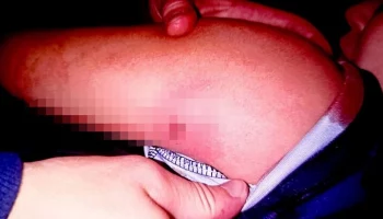 Жительница Подмосковья рассказала, как ее сыну прострелили плечо на футбольном поле