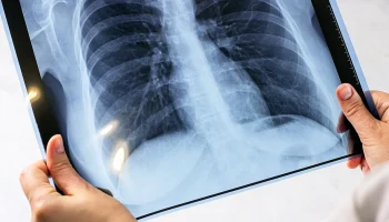 Минздрав РФ: Больные ВИЧ и туберкулезом могут бесплатно лечиться по полису ОМС