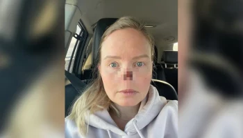 Собака испугалась петарды и откусила нос своей хозяйке