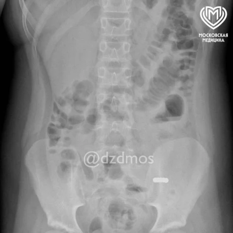Пятилетняя москвичка проглотила магнитные шарики, которые продырявили кишечник