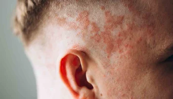 Дерматолог Кривда рассказала, почему возникает псориаз и как облегчить его течение