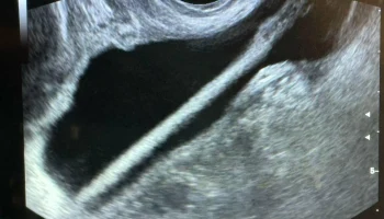 Подмосковные врачи извлекли косметический карандаш из мочевого пузыря женщины