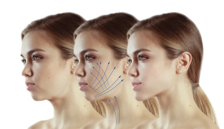 Ultraformer III: революционный SMAS-лифтинг нового поколения Ultraformer III: революционный SMAS-лифтинг нового поколения